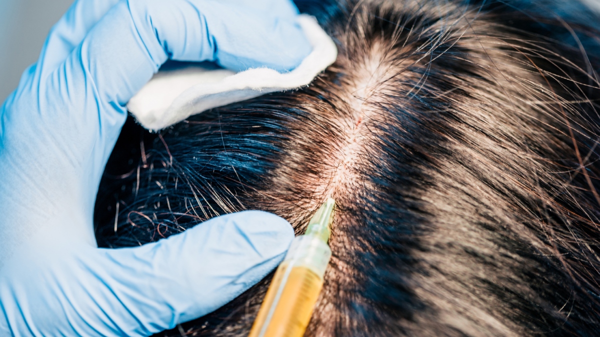 Implante de pelo en una mujer